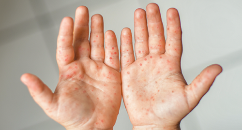 DETECCIÓN DE VIRUS DE SARAMPIÓN Y RUBÉOLA  POR PCR